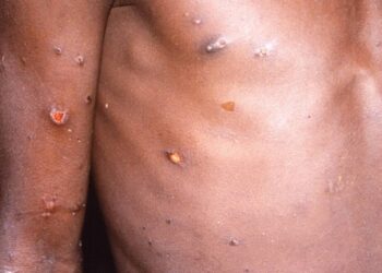 Côte d’Ivoire : 32 cas de la variole du singe confirmés, la surveillance sanitaire renforcée