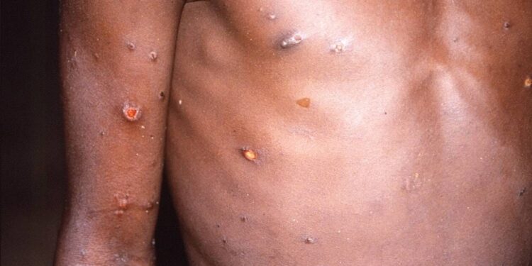 Côte d’Ivoire : 32 cas de la variole du singe confirmés, la surveillance sanitaire renforcée
