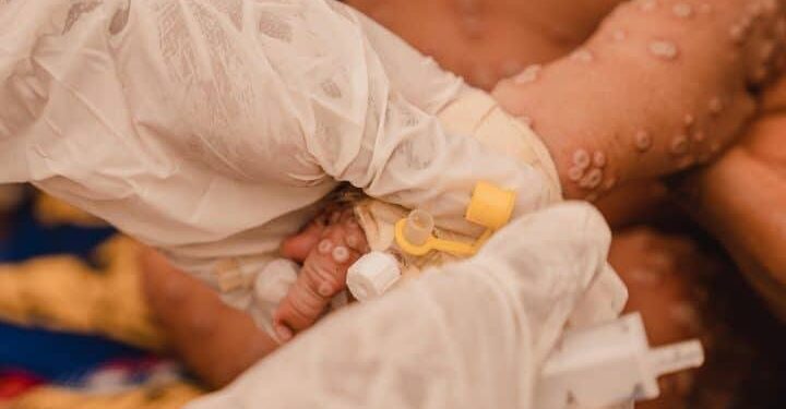 Mpox : Une propagation croissante en zones urbaines inquiète les chercheurs en Afrique